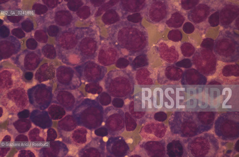 -Bologna,1995.Istituto di ematologia Seragnolidellospedale SantOrsola di Bologna: cellule di midollo osseo colpite da melanoma multiplo. malattia melanoma medicina ospedale scienza -Bologna,1995. SeragnoliInstitute of Hematology:melanoma bone marrow cells ©Graziano Arici/Rosebud2