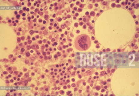 -Bologna,1995.Istituto di ematologia Seragnolidellospedale SantOrsola di Bologna: cellule di midollo osseo normali-Bologna,1995. SeragnoliInstitute of Hematology:normal bone marrow cells